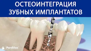 Остеоинтеграция зубных имплантатов ©