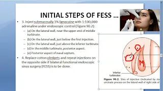 ENT FESS Surgery STEPS Approach how is it done complications post operative care operation