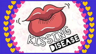 Infectious mononucleosis (Kissing disease): Diagnosis, Clinical feature, Treatment