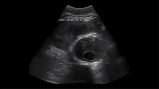 Ruptured abdominal aortic aneurysm (AAA) ultrasound. 02/2022.