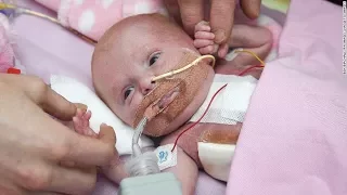 Baby Survives Being Born With Heart Outside Of Her Body!