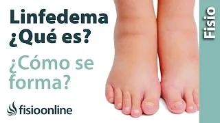 Linfa, edema o linfedema - Qué es y cómo se forma