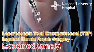 Laparoscopic Total Extraperitoneal (TEP) Inguinal Hernia Repair Surgery - Explained