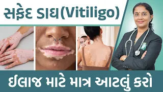 Vitiligo Ayurved Treatment  | Dr. Devangi Jogal | JOGI Ayurved