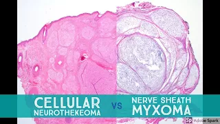 Cellular Neurothekeoma vs Nerve Sheath Myxoma - Dermpath Lookalikes