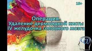 Операция. Удаление опухоли (дермоидной кисты) IV желудочка головного мозга. Нейрохирургия