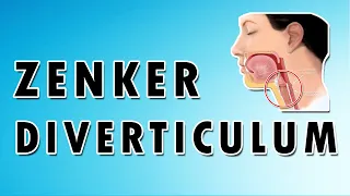 Zenker's Diverticulum