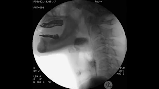 Large epiglottic cyst (preop) 1/2