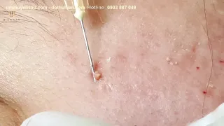 Extract hidden acne with a brave Girl at hien van spa|432| Ngoc Thuy