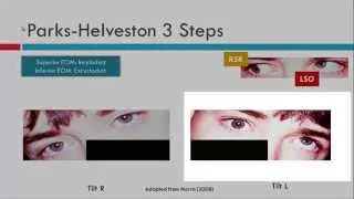 Parks-Helveston 3 Step Test & Bielschowsky Head Tilt Test