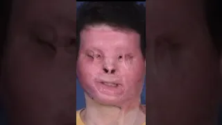 Joe DiMeo: First successful face and hand transplant recipient in the world