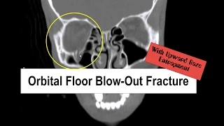 Blow Out Fracture with Upward Gaze Entrapment