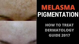 How to treat pigmentation