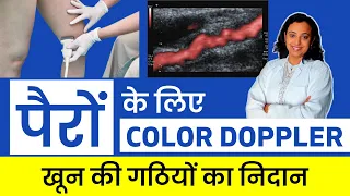 Color Doppler of Leg | पैरों का Ultrasound कैसे होता है?