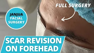 SCAR REVISION ON FOREHEAD SCAR (FULL SURGERY) - DR. TANVEER JANJUA - NEW JERSEY