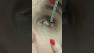 Cryosurgery of eyelid papilloma | Кріохірургія папіломи повіки | Криохирургия папилломы века