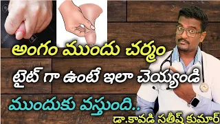 Phimosis Treatment(Tight Forskin Solution) in Telugu || Doctor Satheesh || Yes1TV