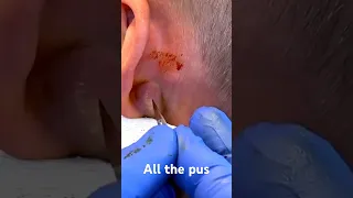 Major Ear Abscess!!! - Dr. Paul (Retired)