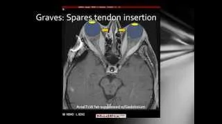 Graves Disease - Thyroid Orbitopathy