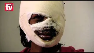 Twenty three...and scarred for life - Acid attack victim speaks