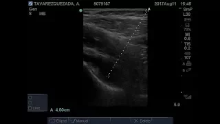 US Guided Hip Arthrocentesis in 9 yo Boy with Limp