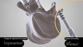 Hyprevention: V STRUT Operative Technique USA