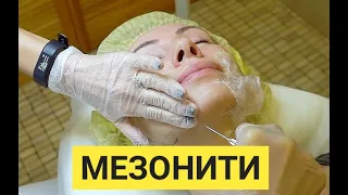 Ставим мезонити для улучшения овала лица