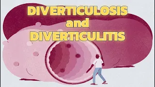 Diverticulosis and Diverticulitis - CRASH! Medical Review Series