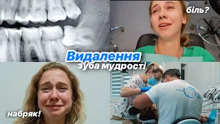 VLOG: Видаляю зуб мудрості 🦷 Як проходить процедура? Чи боляче?😭 Мій досвід