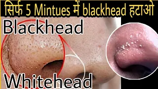 How to remove blackhead permanently / सिर्फ 5 minutes में ब्लैक हेड और वाइट हेड हटाओ #blackhead