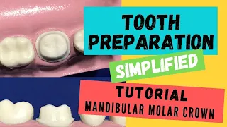 Zirconia Crown Preparation DEMONSTRATION. (Super Simplified)