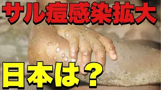 【サル痘ウイルス】天然痘に似た「サル痘」ウイルス感染症！欧米でこれまでにない規模で感染拡大！
