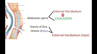 Ophthalmology 375 External hordeolum Stye Chalazion Internal Difference Compare Glands Eyelid eye