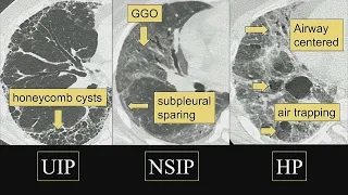 Mosaic Lung Attentuation