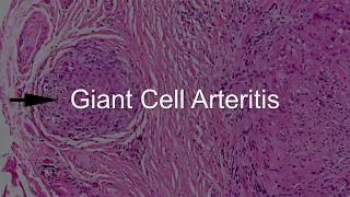 Giant Cell Arteritis (Vasculitis) - An Overview