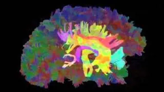 New MRI Reveals Mysteries of Brain Injuries