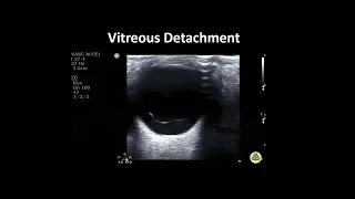 Retinal Detachment