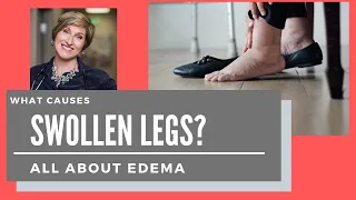 EDEMA - What causes swollen legs and feet?