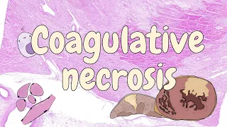 Coagulative necrosis - general pathology