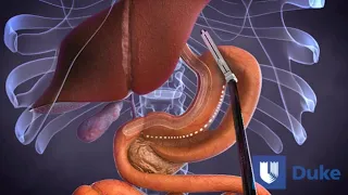 Duodenal Switch Surgery | Duke Health