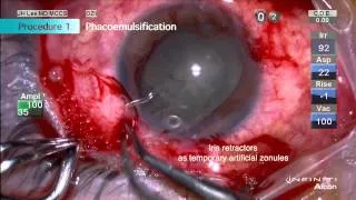 [HD] Anterior segment reconstruction after ocular trauma