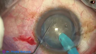 Hard cataract with anterior capsular Fibrosis - unedited and real-time: Pradip Mohanta, 15 Oct 2023