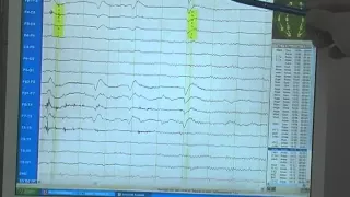 EEG - Die Elektroenzephalografie