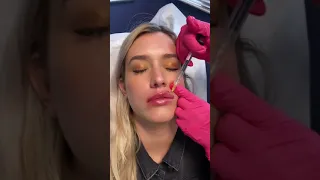 LIP FILLER: PICKET FENCE TECHNIQUE 🥳