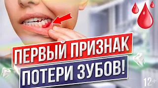 ВОСПАЛЕНИЕ ДЕСЕН - Самая распространенная причина потери зубов!