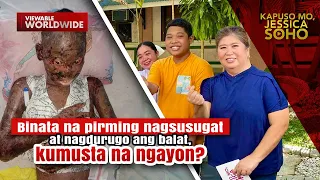 Binata na pirming nagsusugat ang balat, tuluyan nang nagbago ang buhay | Kapuso Mo, Jessica Soho