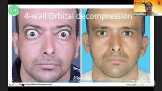 AIOC2021 -  IC353 - Topic -  Dr TARJANI DAVE - Customized orbital decompression case scenarios ..