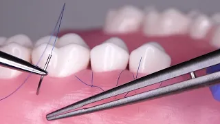 Sling Suture