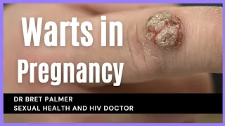 Genital warts in pregnancy, what to do!
