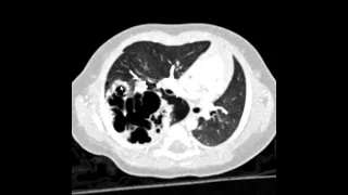 Malformação adenomatóide cística